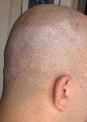 Seborrheic dermatitis natural treatment | General center | SteadyHealth.com