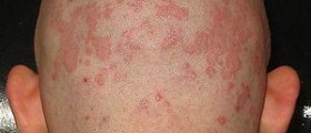 Seborrheic dermatitis symptoms