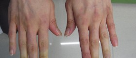 Cold Hands: Raynaud's Disease