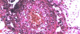 Vasculitis