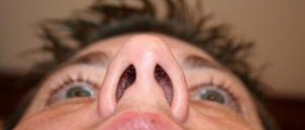 Septoplasty recovery tips