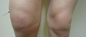 Sharp knee pain