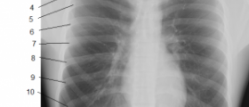 Sharp pain in ribs