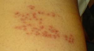 Shingles in children review