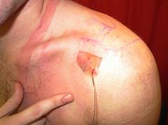 Shoulder pain when lifting arm