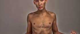 Eating Disorders (Anorexia, Bulimia and Binge Eating) Among Males Becoming Common
