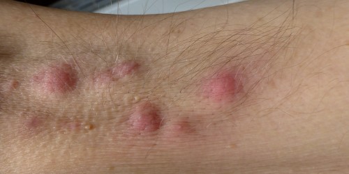 There Is A Cure For Hidradenitis Suppurativa