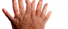 Connection between Carpal Tunnel Syndrome (CTS) & Arthritis