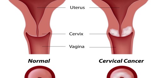 How Often Should I Get a Pap Test? New Guidelines for Cervical Cancer Screening