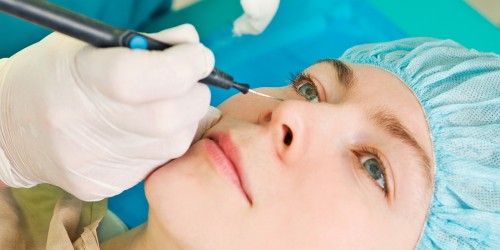 Rhytidectomy: Face Lifting procedure