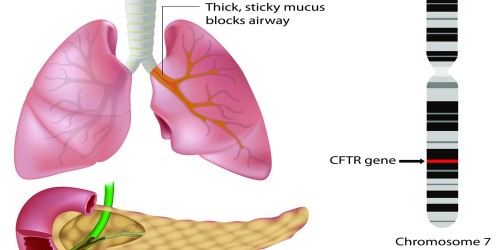 Living with Cystic Fibrosis