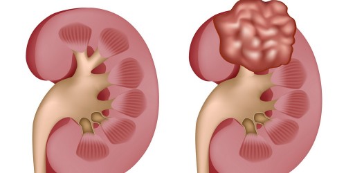 Kidney Cancer - Risks, Symptoms, Treatment, and Prevention Tips