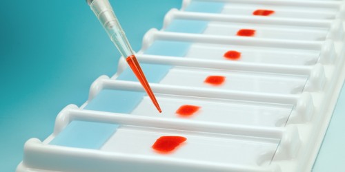 Human Genome Sciences Inc. Won the FDA Approval for the First New Lupus Treatment