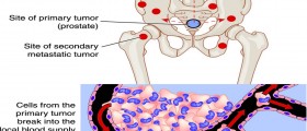 Prostate Cancer: Should A PSA Screening Be A Routine Part Of Medical Care?