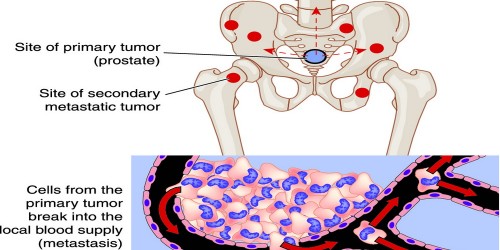 Prostate Cancer: Should A PSA Screening Be A Routine Part Of Medical Care?