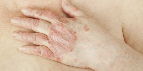 Link Between Psoriasis And Hypertension