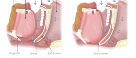 Why Specialized Care For Sleep Apnea Is Important