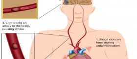 Catching Clots, Preventing Strokes