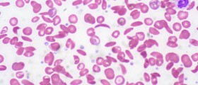 Sickle Cell Anemia: Symptoms, Diagnosis And Treatment