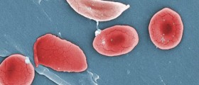 Hope for a Cure: Sickle Cell Disease