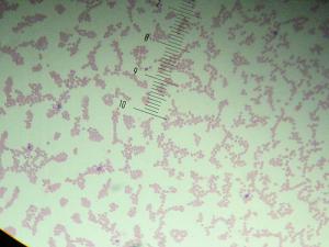 Sickle cell anemia life expectancy