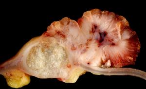 Side effects of chemotherapy for colon cancer