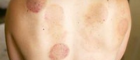 Side effects of cupping therapy