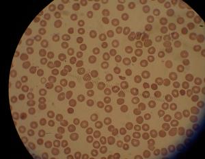 Side effects of malaria tablets