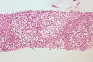 Signs and symptoms of alcoholic liver disease