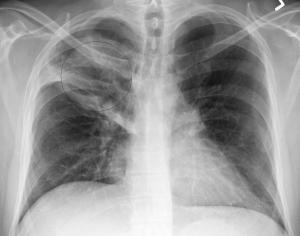 Signs and symptoms of Pneumonia: is Pneumonia contagious ?
