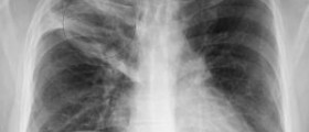 Signs and symptoms of Pneumonia: is Pneumonia contagious?