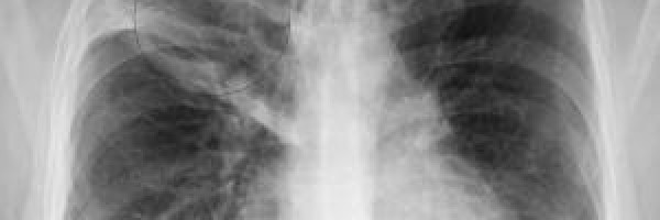 Signs and symptoms of Pneumonia: is Pneumonia contagious?