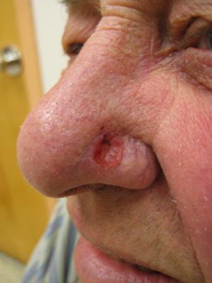 Signs of basal cell carcinoma