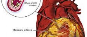 Silent heart attack symptoms