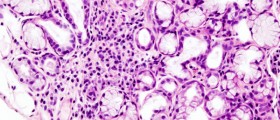 Sjogren s Syndrome: Causes & Symptoms