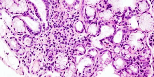 Sjogren s Syndrome: Causes & Symptoms