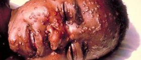 Skin diseases caused by viruses