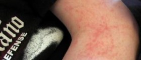 Skin rash natural remedies