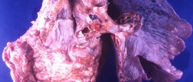 Are You A Candidate For Lung Cancer Screening?
