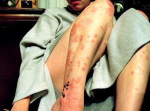 Some alternative approaches to dealing with psoriasis