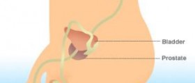 Some thoughts about prostate cancer treatment options