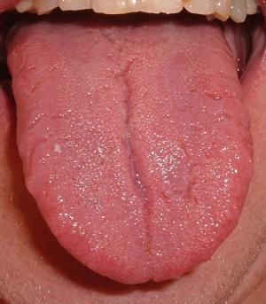 Sore tip of tongue