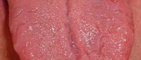 Sore tip of tongue