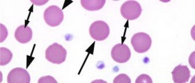 Hereditary spherocytosis