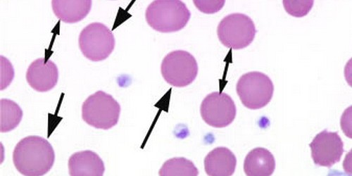 Hereditary spherocytosis