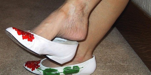 Sclerotherapy: Spider Vein Treatment