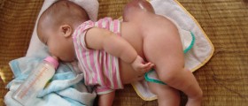 Neural Tube Defects: Spinal Bifida & Anencephaly