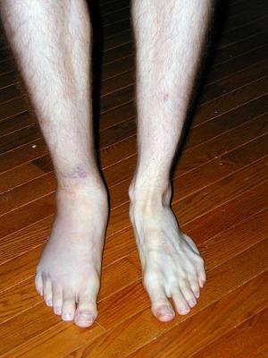 Sprained ankle causes and symptoms