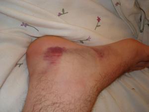 Sprained ankle recovery
