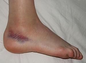 Sprained ankle treatment